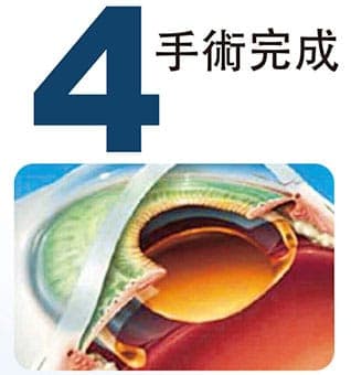 4.手術完成